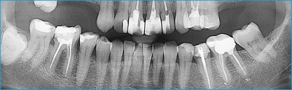 Лечение зубов с проблемными труднопроходимыми корневыми каналами